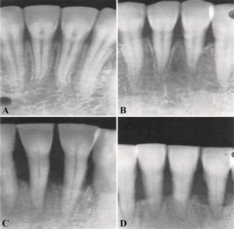 Role of Radiographic Evolution: An Aid to Diagnose Periodontal Disease | IntechOpen