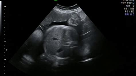 36 week baby ultrasound scan - YouTube