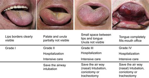 The Angiotensin-Converting-Enzyme-Induced Angioedema - Immunology and Allergy Clinics