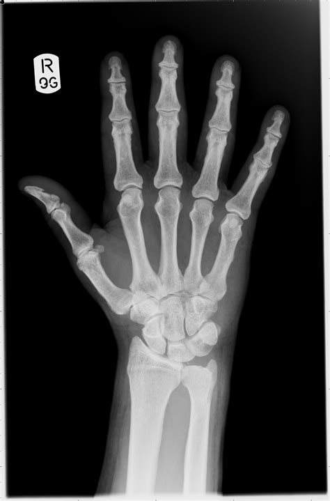 Hand x-ray. Causes, symptoms, treatment Hand x-ray