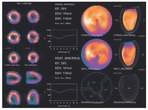 Nuclear Cardiology | Radiology Key