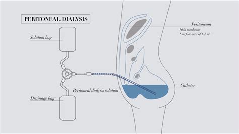 Peritoneal Dialysis Ati Template