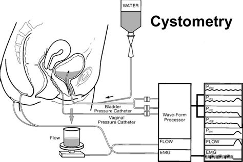 Cystometry, cystometry procedure, preparation, results & risks