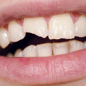 牙齒斷裂：破損、斷裂牙齒該怎麼辦？如何治療？｜快樂牙齒 Happy Teeth