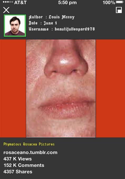 Phymatous Rosacea Pictures 085623 - Rosacea Free Forever.