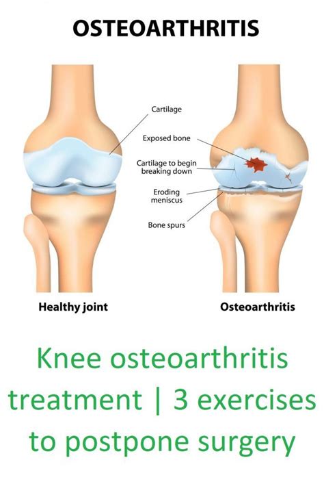 Knee osteoarthritis treatment – Artofit