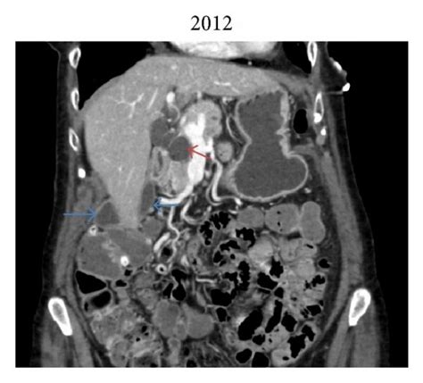 (a), (b), and (c) show computed tomography axial images of the abdomen... | Download Scientific ...