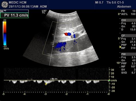 VIETNAMESE MEDIC ULTRASOUND: CASE 223: BIG IVC, Dr PHAN THANH HẢI- Dr ...