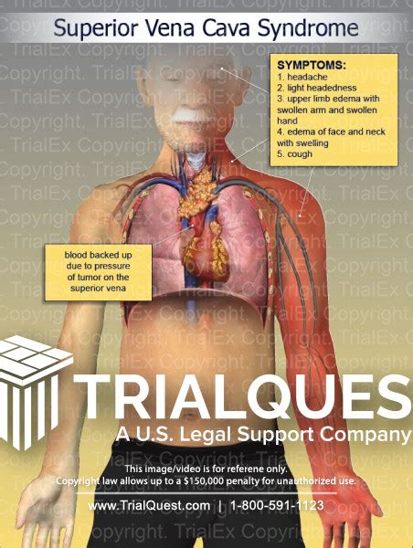 Superior Vena Cava Syndrome - Trial Exhibits Inc.