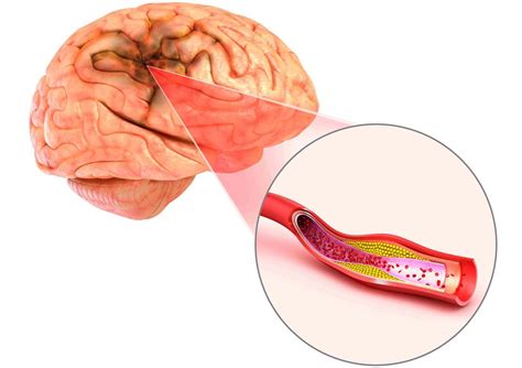 La trombólisis intravenosa, asociada con la supervivencia a largo plazo ...