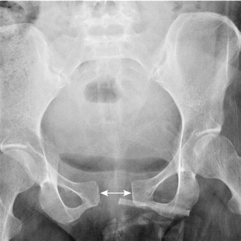 (PDF) Postpartum symphysis pubis diastasis