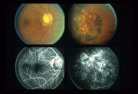 Eales Disease - Retina Image Bank