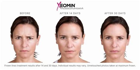 Xeomin Before and After in Las Vegas, NV