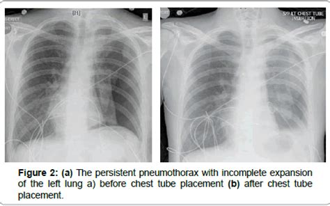 Pneumothorax Ex Vacuo Following Thoracentesis for Persistent Pleural ...