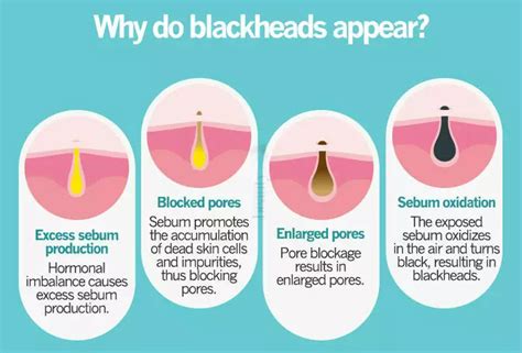 How To Get Rid of Blackheads – THE YESSTYLIST