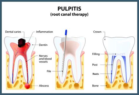 Root Canal Treatment - Dr. Feldstein, DDS