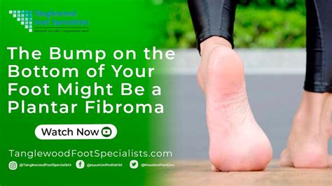 The Bump on the Bottom of Your Foot Might Be a Plantar Fibroma - YouTube