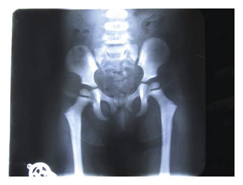 Coxa valga deformity in PDO sufferers. | Download Scientific Diagram