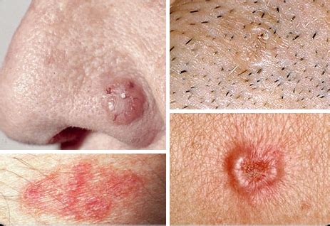 What is Skin Cancer? - South Coast Dermatology & Cosmetic Center Blog