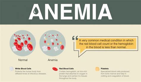 Overview of Anemia: Signs, Symptoms, Causes and Treatment