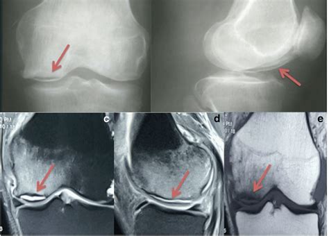 Medial Femoral Condyle Fracture