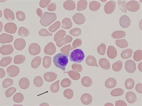 teardrop cells myelofibrosis