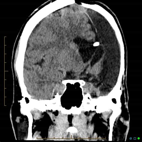 Hemispherectomy indications, prognosis, risks, side effects & complications