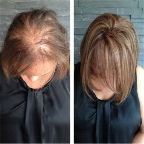 best way to hide thinning hair in the front woman - Claretha Dill