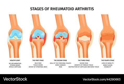 Rheumatoid arthritis stages infographics Vector Image