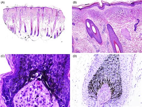 Histopathology of aging of the hair follicle - Fernandez‐Flores - 2019 - Journal of Cutaneous ...