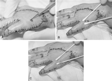 121: Skin Graft Care | Clinical Gate