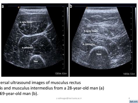 Echogenicity: Implication of Rehabilitative Ultrasound Imaging for As…