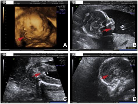 The arrow denotes the site of fetal ultrasound showing bilateral ...