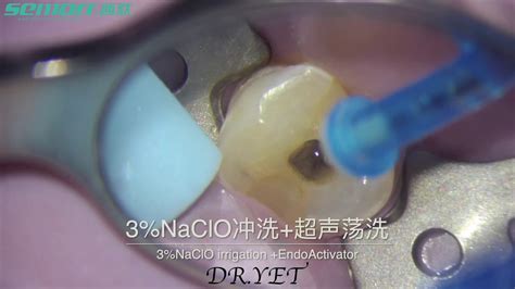 Premolar Root Canal Treatment Dr Yet - YouTube