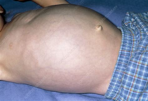 Swollen abdomen due to hepatomegaly from cancer - Stock Image M131/0335 - Science Photo Library