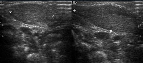 Fibromatosis colli | Image | Radiopaedia.org