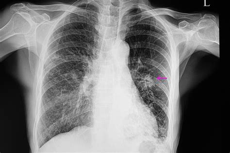 New Drug to Treat Pneumonia | The Oldish®