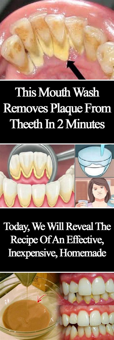 Click The Image — This Mouthwash Removes Plaque From Teeth In 2...