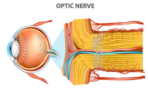 Optic Nerve Swelling (Papilledema) - Harvard Health