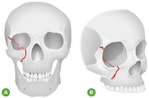 Fractured Eye Socket X Ray