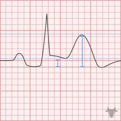 Acute Pericarditis | ECG Stampede