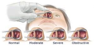 Nasal Obstruction/Congestion - Southern California Sinus Institute