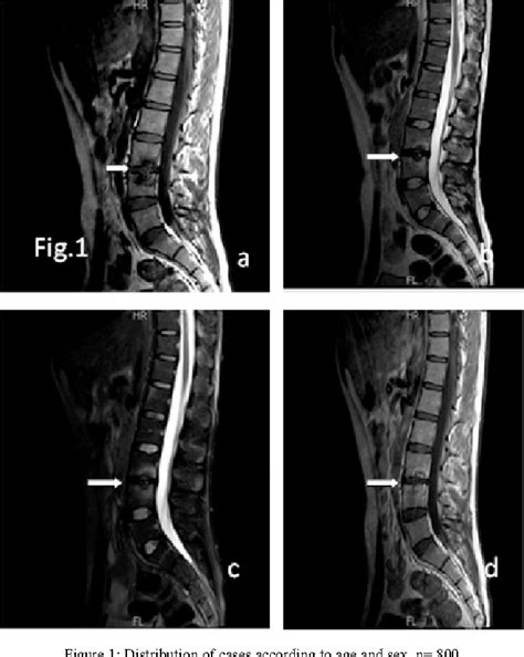 [PDF] Spinal changes in patients with ankylosing spondylitis on MRI ...