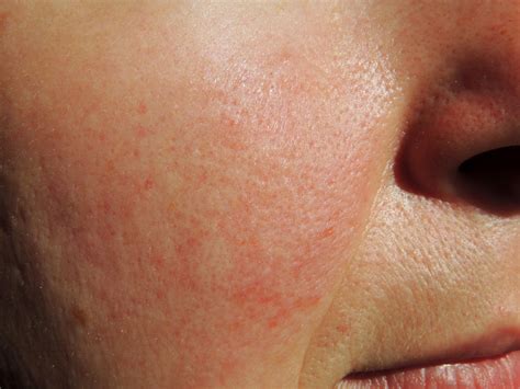 Rosacea Treatment in Hagerstown, Maryland