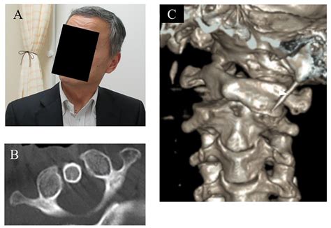 Surgical treatment for atlantoaxial rotatory fixation in an adult with ...