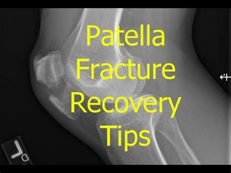 Patella Fracture Recovery tips - YouTube