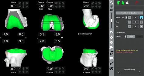 Robotic knee replacement surgery enhances precision, personalization | Orthopaedics and Rehab ...