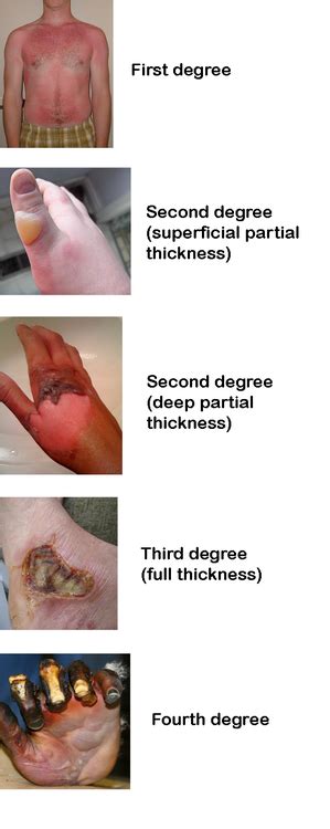 Burn Degrees | Burn injury, Medical science, Emergency medical