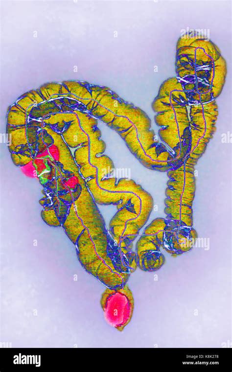 COLON CANCER CT SCAN Stock Photo - Alamy