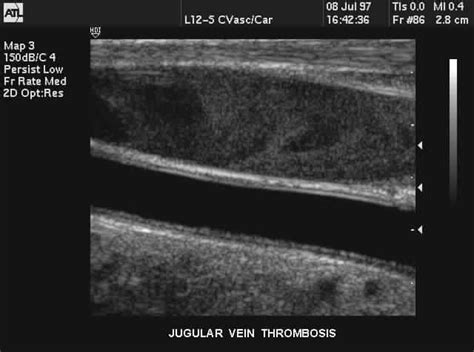 Jugular vein thrombosis | Medical ultrasound, Vascular ultrasound, Vein ...